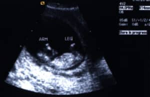 sonogram