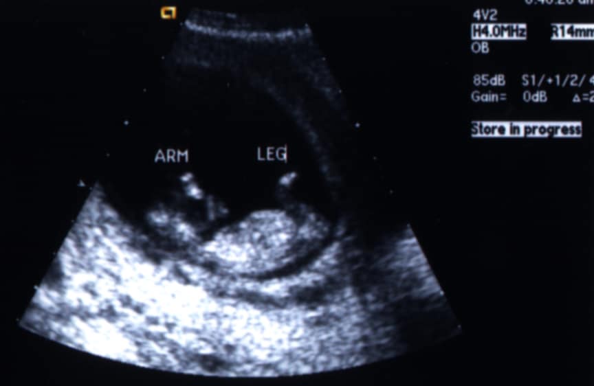 sonogram
